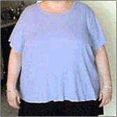 Gastric Bypass Surgery Before