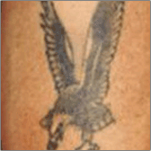 Tattoo Removal Before
